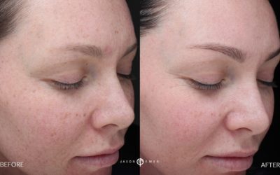 Innovative treatment: Microneedling