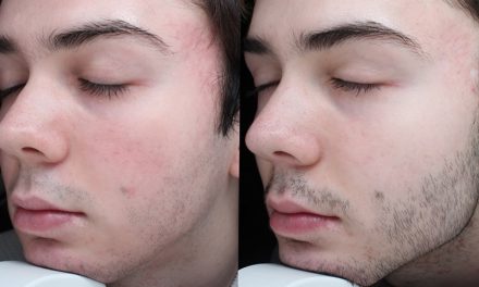 Fractora Skin Remodeling