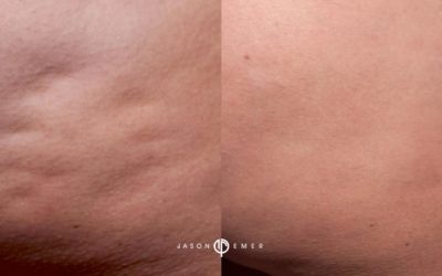 Dr. Jason Emer: Cellulite