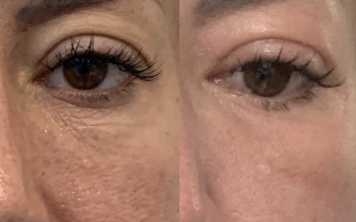 Surgical Lower Blepharoplasty