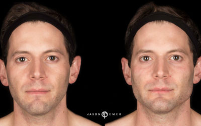 Male Facial Sculpting