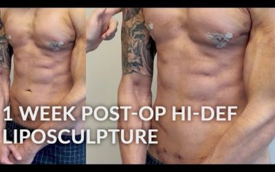 Dr. Jason Emer: HD Liposculpture