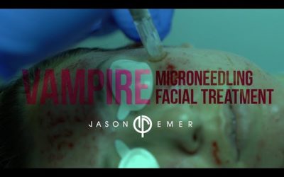 Skin Gym treatment: Vampire Facial