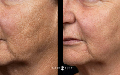 Fraxel Laser: Skin Resurfacing