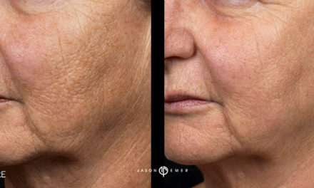 Fraxel Laser: Skin Resurfacing