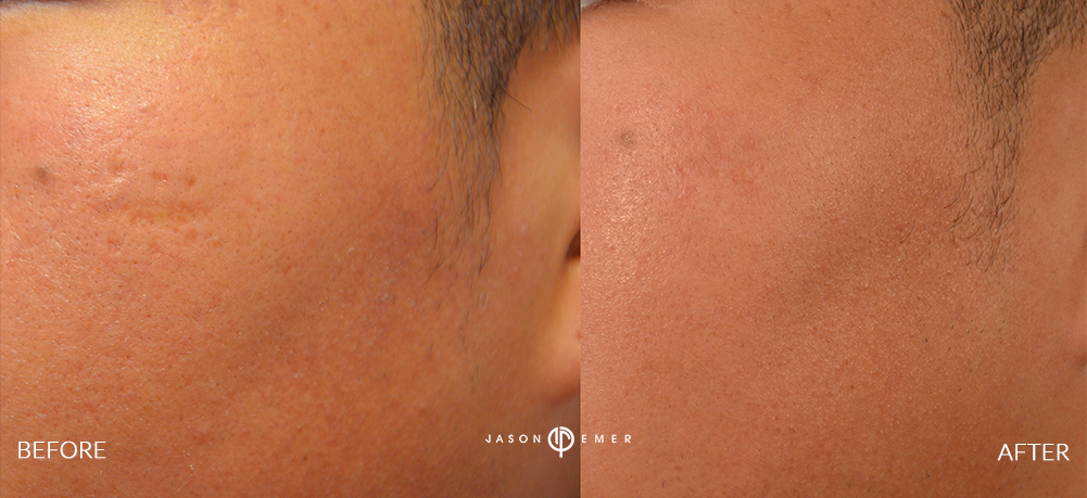 Scar Fraxel laser treatments