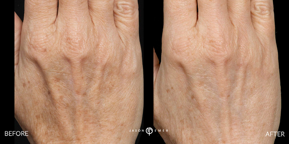 Hand Rejuvenation