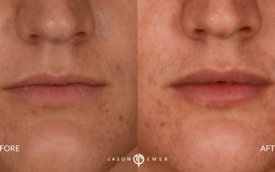 Dr. Jason Emer: Lip Augmentation