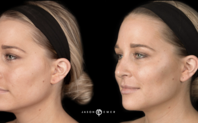 Cheek Augmentation