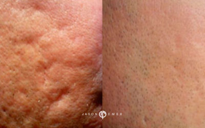 Treating Acne Scars with RF Microneedling and Dermal Fillers