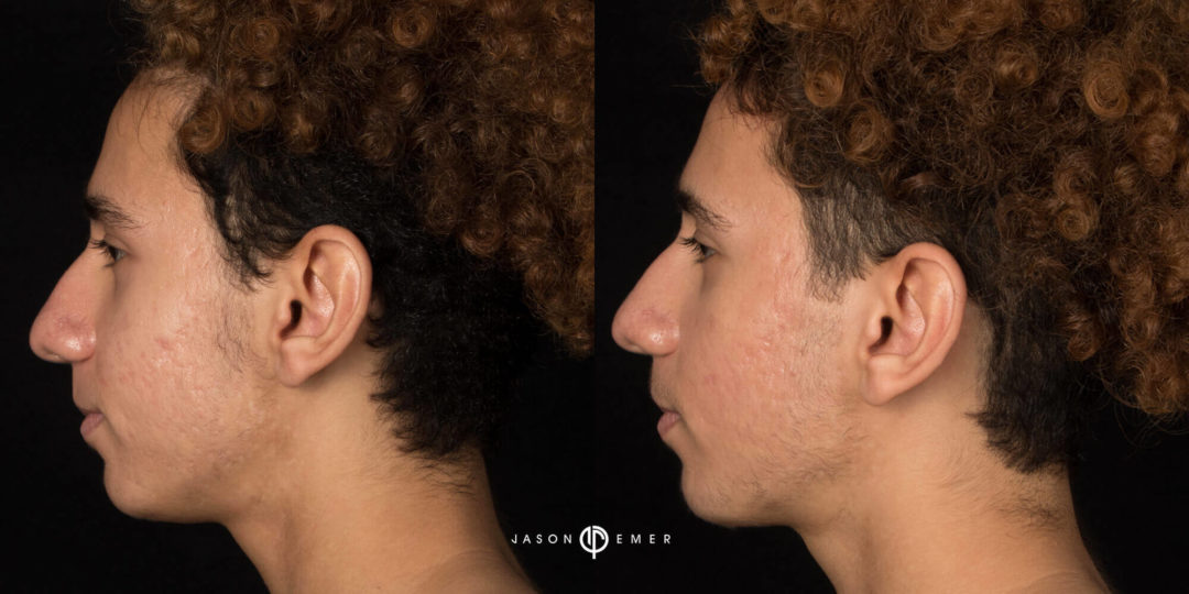 Acne Scar Treatment Before and After Photo by Dr. Emer in West Hollywood California