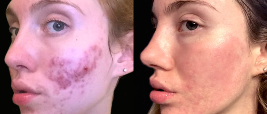 Acne Scar Treatments Before and After Photo by Dr. Emer in West Hollywood California