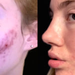 Acne Scar Treatments Before and After Photo by Dr. Emer in West Hollywood California