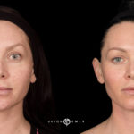 Microneedling Before and After Photo by Dr. Emer and Dr. Sanan in West Hollywood California