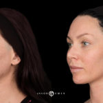 Microneedling Before and After Photo by Dr. Emer and Dr. Sanan in West Hollywood California