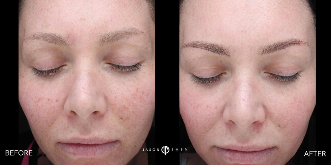 Microneedling Before and After Photo by Dr. Emer and Dr. Sanan in West Hollywood California