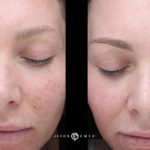 Microneedling Before and After Photo by Dr. Emer and Dr. Sanan in West Hollywood California