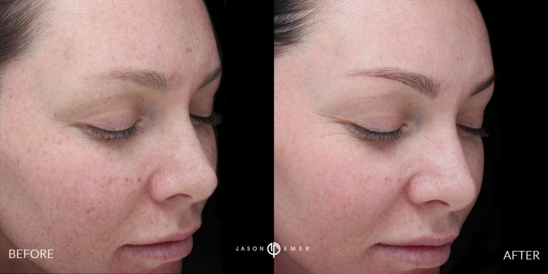 Microneedling Before and After Photo by Dr. Emer and Dr. Sanan in West Hollywood California