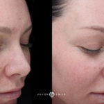 Microneedling Before and After Photo by Dr. Emer and Dr. Sanan in West Hollywood California