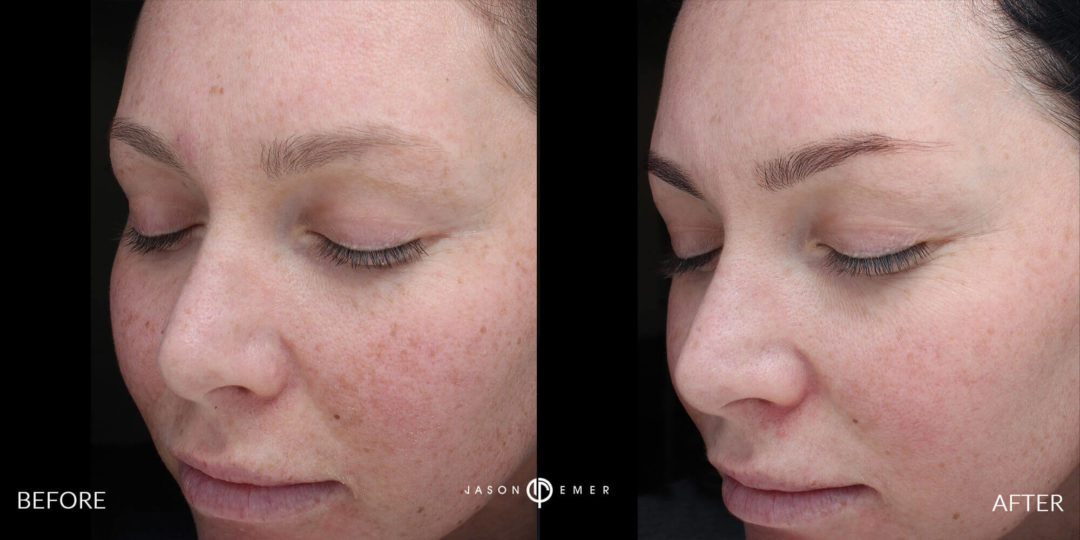 Microneedling Before and After Photo by Dr. Emer and Dr. Sanan in West Hollywood California