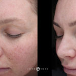 Microneedling Before and After Photo by Dr. Emer and Dr. Sanan in West Hollywood California