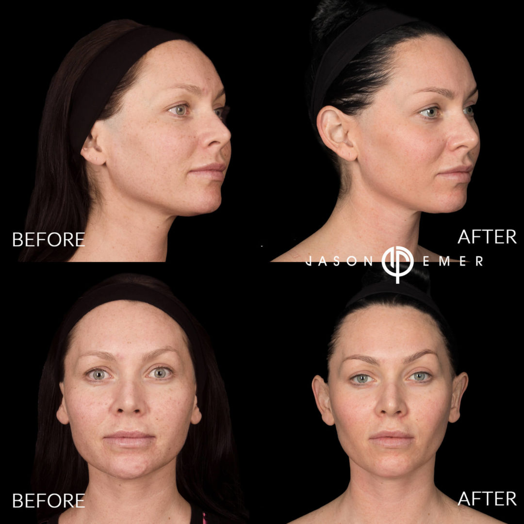 Microneedling Before and After Photo by Dr. Emer and Dr. Sanan in West Hollywood California