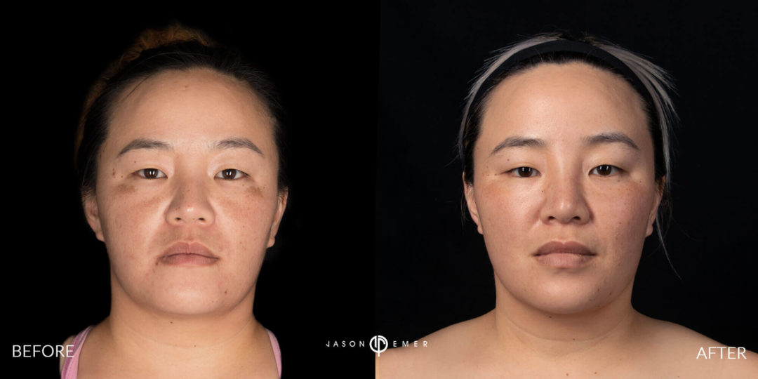 Microneedling Before and After Photo by Dr. Emer and Dr. Sanan in West Hollywood California