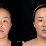 Microneedling Before and After Photo by Dr. Emer and Dr. Sanan in West Hollywood California