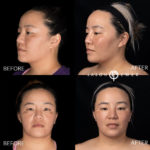 Microneedling Before and After Photo by Dr. Emer and Dr. Sanan in West Hollywood California