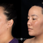 Microneedling Before and After Photo by Dr. Emer and Dr. Sanan in West Hollywood California