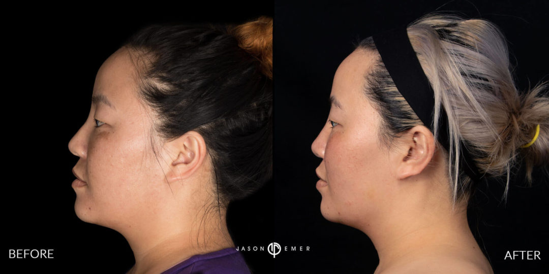 Microneedling Before and After Photo by Dr. Emer and Dr. Sanan in West Hollywood California