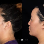 Microneedling Before and After Photo by Dr. Emer and Dr. Sanan in West Hollywood California