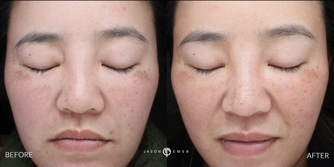 Microneedling Before and After Photo by Dr. Emer and Dr. Sanan in West Hollywood California