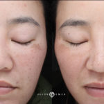 Microneedling Before and After Photo by Dr. Emer and Dr. Sanan in West Hollywood California