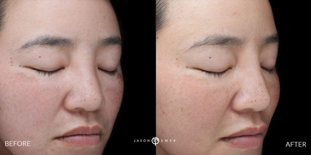 Microneedling Before and After Photo by Dr. Emer and Dr. Sanan in West Hollywood California