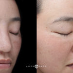 Microneedling Before and After Photo by Dr. Emer and Dr. Sanan in West Hollywood California