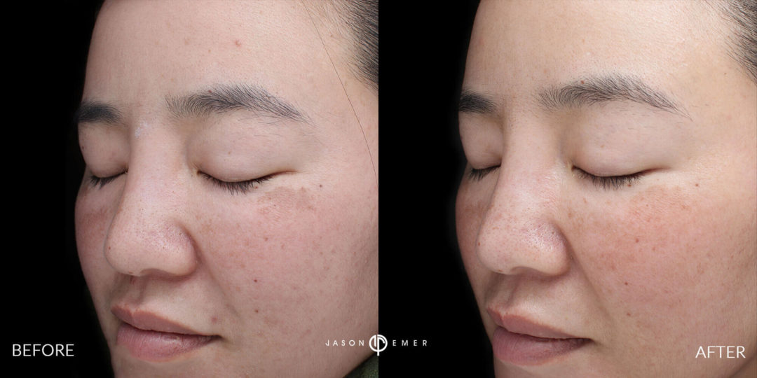 Microneedling Before and After Photo by Dr. Emer and Dr. Sanan in West Hollywood California