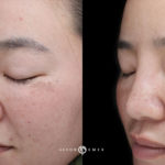 Microneedling Before and After Photo by Dr. Emer and Dr. Sanan in West Hollywood California