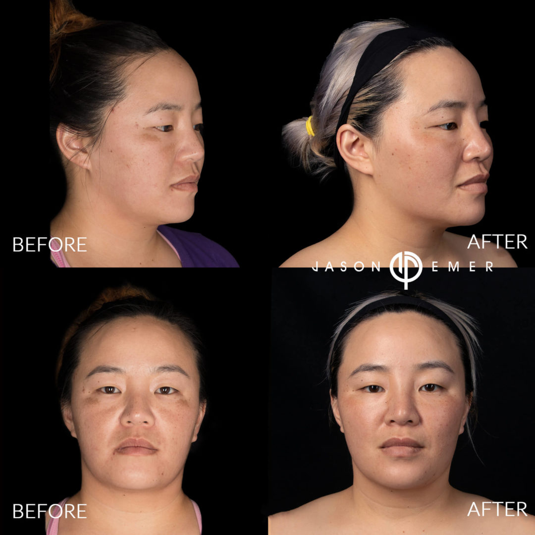 Microneedling Before and After Photo by Dr. Emer and Dr. Sanan in West Hollywood California