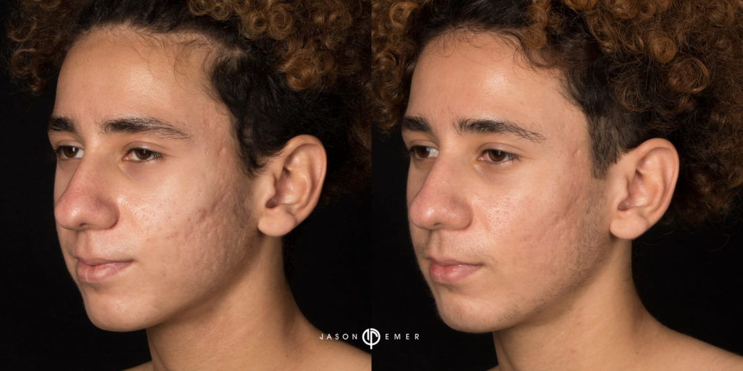 Acne Scar Treatment Before and After Photo by Dr. Emer in West Hollywood California