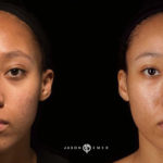 Pore Treatment Before and After Photo by Dr. Emer and Dr. Sanan in West Hollywood California