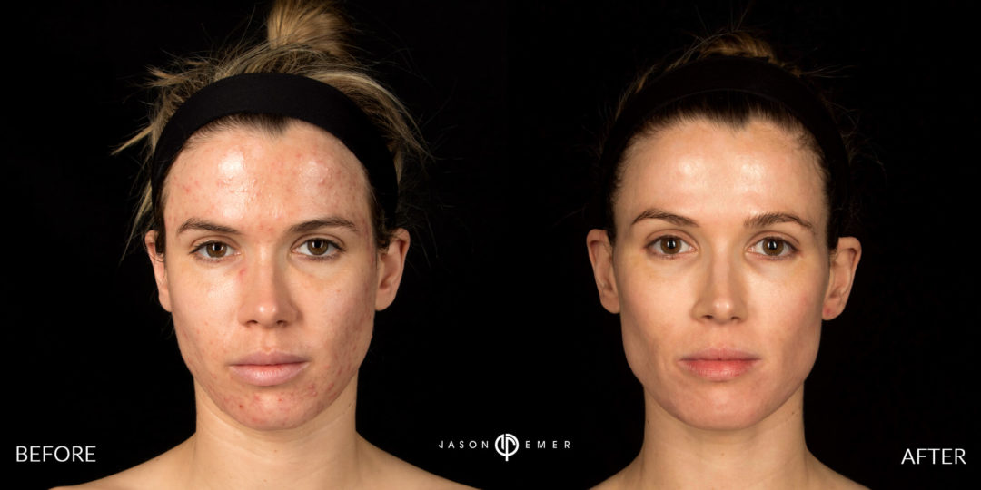 Acne Scar Laser Treatment Before and After Photo by Dr. Emer in West Hollywood California