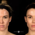 Acne Scar Laser Treatment Before and After Photo by Dr. Emer in West Hollywood California