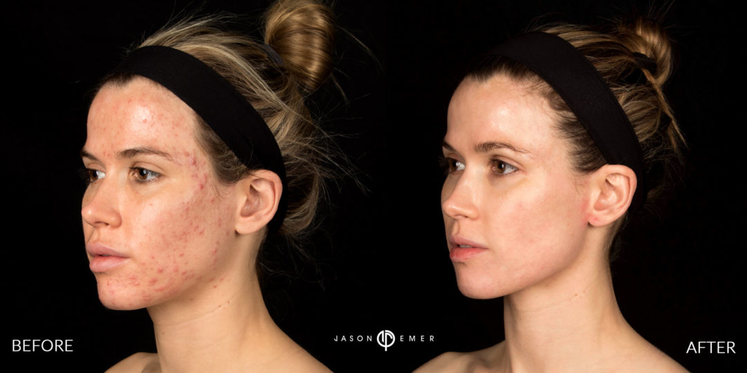 Acne Scar Laser Treatment Before and After Photo by Dr. Emer in West Hollywood California