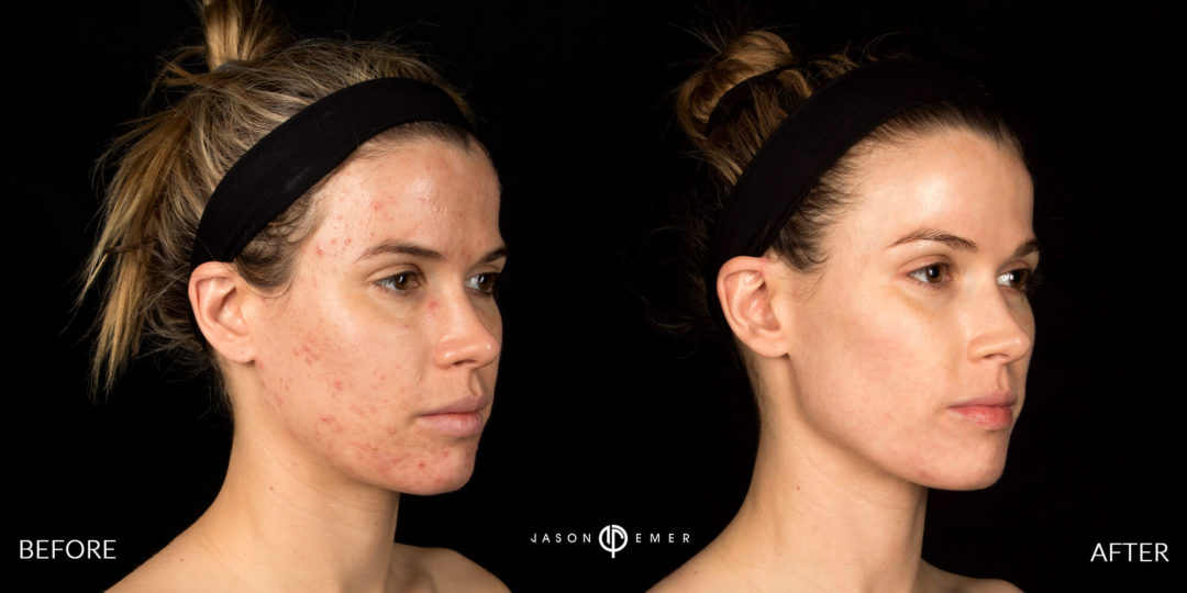 Acne Scar Laser Treatment Before and After Photo by Dr. Emer in West Hollywood California