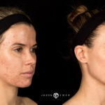 Acne Scar Laser Treatment Before and After Photo by Dr. Emer in West Hollywood California