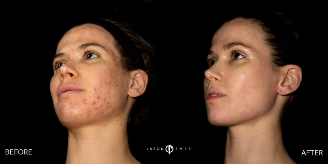 Acne Scar Laser Treatment Before and After Photo by Dr. Emer in West Hollywood California