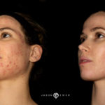 Acne Scar Laser Treatment Before and After Photo by Dr. Emer in West Hollywood California