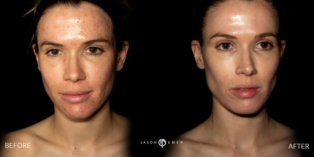 Acne Scar Laser Treatment Before and After Photo by Dr. Emer in West Hollywood California