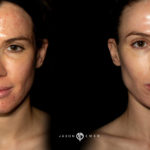 Acne Scar Laser Treatment Before and After Photo by Dr. Emer in West Hollywood California